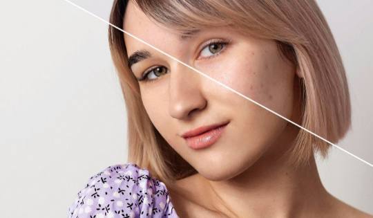 5 эффективных способов сузить поры на лице