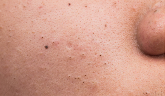 Виды новообразований на коже и способы их лечения
