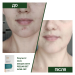 Противовоспалительный пилинг для лица Контроль дефектов Peeling SET Acne-off - фото №4