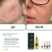 Противовоспалительный тоник для проблемной кожи Acne-Off control toner (миниатюра), 50 мл - фото №3