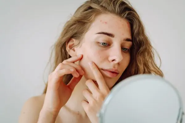 Как безопасно выдавить прыщ? - MyIDi