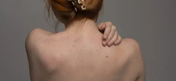 Почему появляются прыщи на спине? - MyIDi