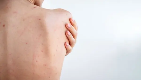 Как быстро избавиться от прыщей на груди? - MyIDi