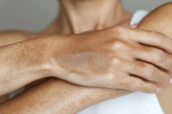 Пігментні плями на руках: причини? - MyIDi