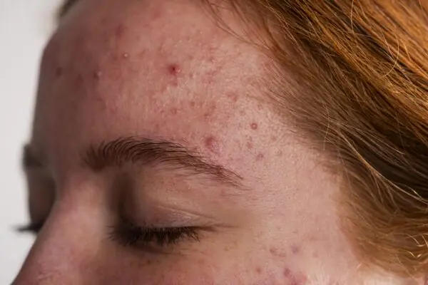 Что делать если на лбу появились прыщи? - MyIDi