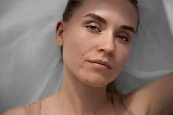 Як прибрати висип після загару? - MyIDi Як прибрати висип після загару? - MyIDi