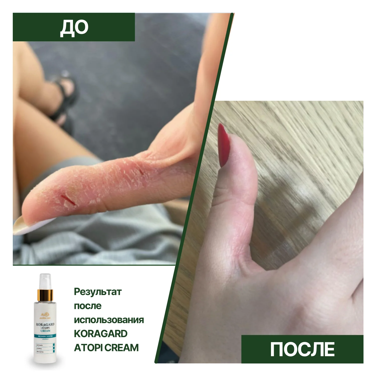 Питательный крем для сухой кожи лица KORAGARD atopi cream (пробник), 5 мл - фото №3