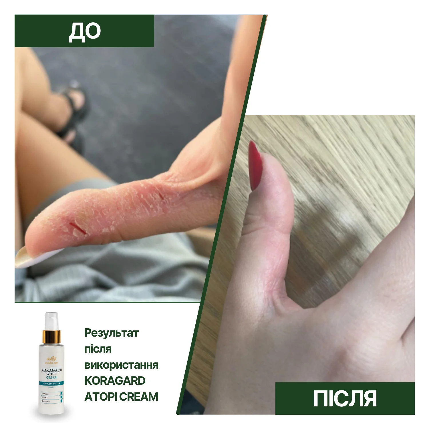 Регенерирующий крем для лица  KORAGARD atopi cream (пробник), 5 мл - фото №3