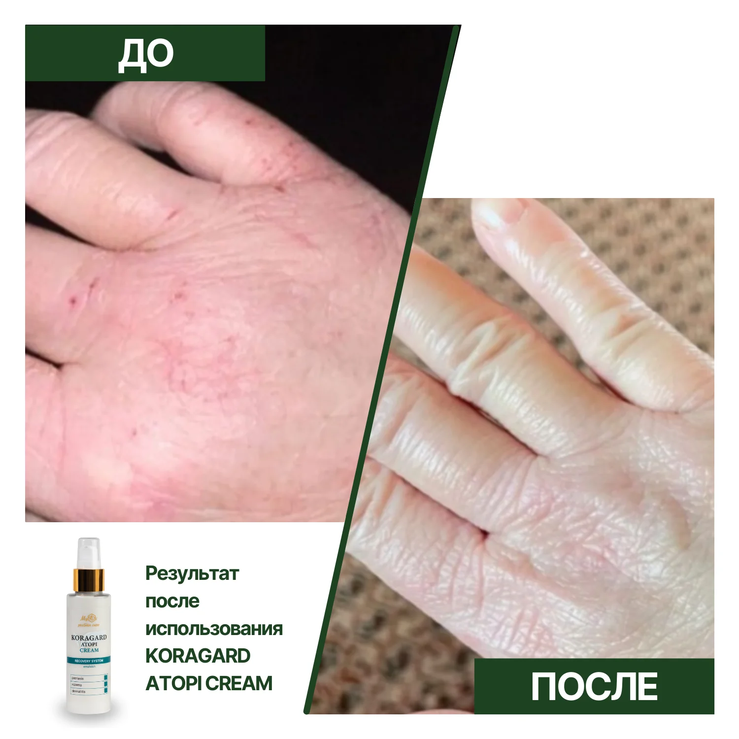 Питательный крем для сухой кожи лица KORAGARD atopi cream (пробник), 5 мл - фото №2
