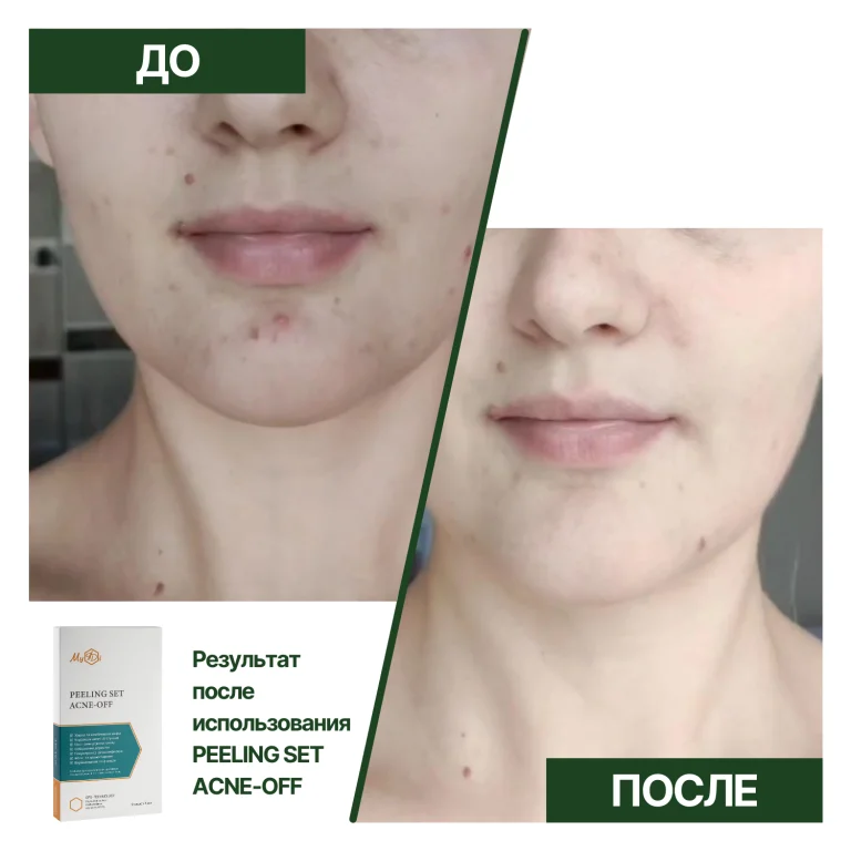 Противовоспалительный пилинг для лица Контроль дефектов Peeling SET Acne-off - фото №4