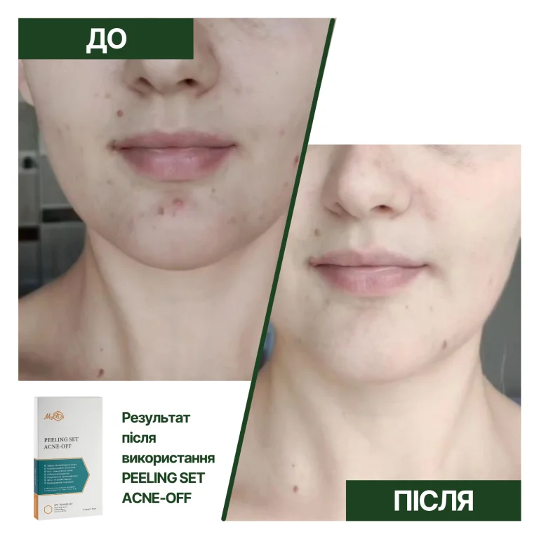 Противовоспалительный пилинг лица Контроль дефектов Peeling SET Acne-off - фото №4