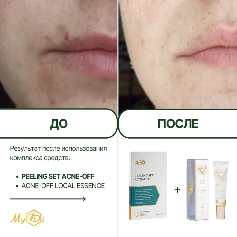 Противовоспалительный пилинг для лица Контроль дефектов Peeling SET Acne-off - фото №5