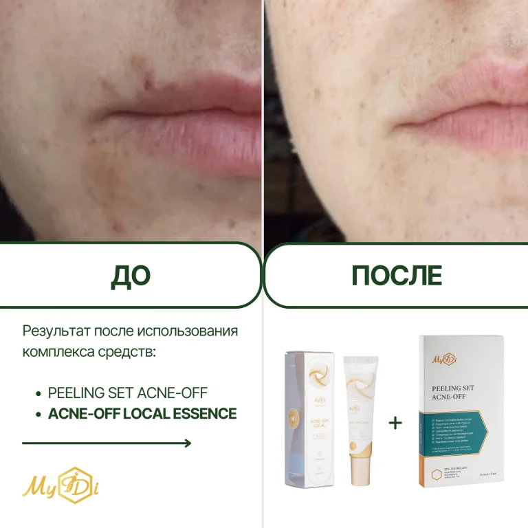 Противовоспалительная локальная эссенция Acne-Off local essence, 15 мл - фото №10