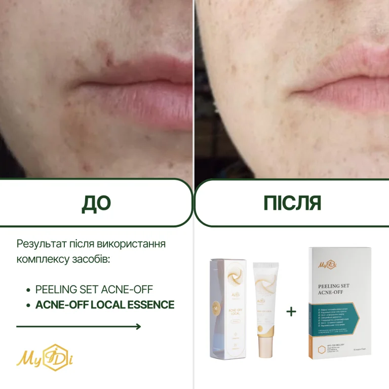 Протизапальна локальна есенція Acne-Off local essence, 15 мл - фото №10