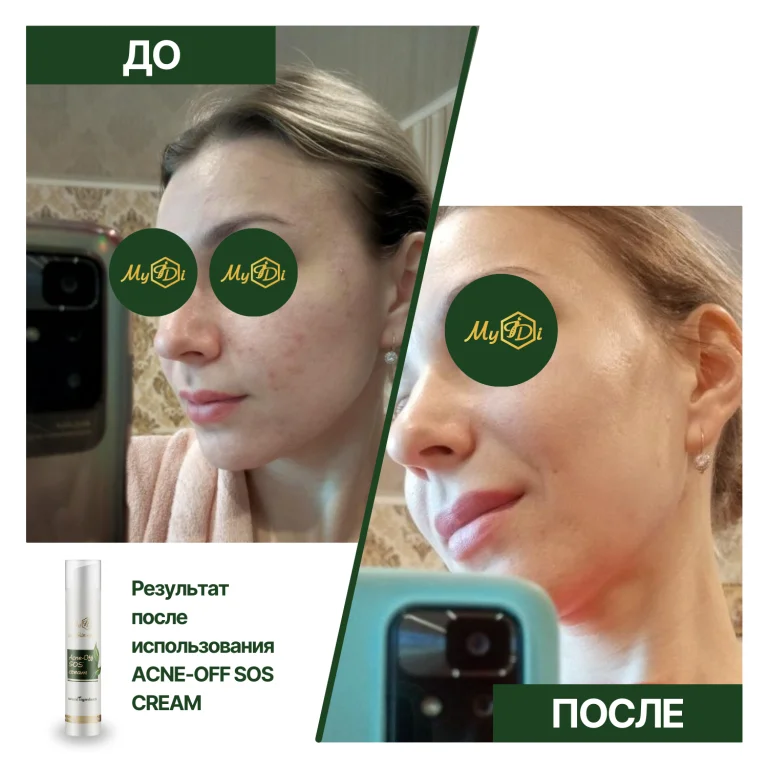 Противовоспалительный крем для лица для проблемной кожи Acne-Off SOS cream (пробник), 5 мл - фото №3