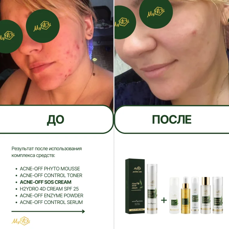 Противовоспалительный крем для лица для проблемной кожи Acne-Off SOS cream (пробник), 5 мл - фото №9