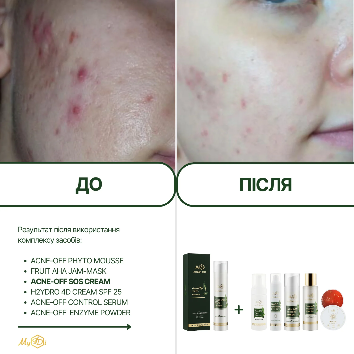 Анти акне крем с кислотами для жирной кожи Acne-Off SOS cream (пробник), 5 мл - фото №8