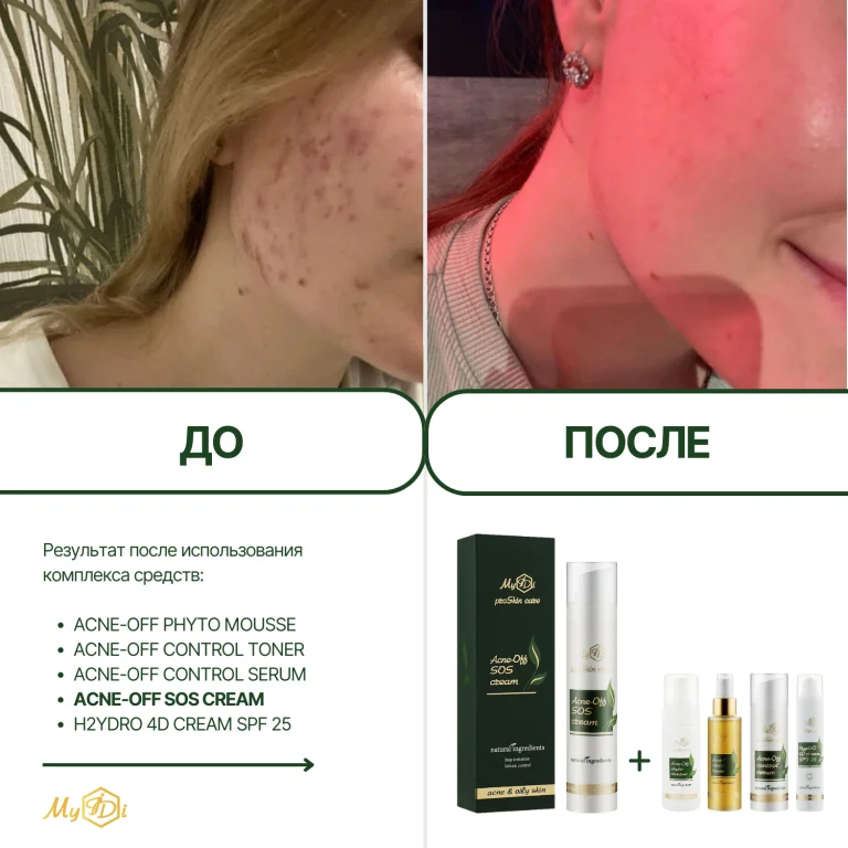 Противовоспалительный крем для лица для проблемной кожи Acne-Off SOS cream (пробник), 5 мл - фото №7