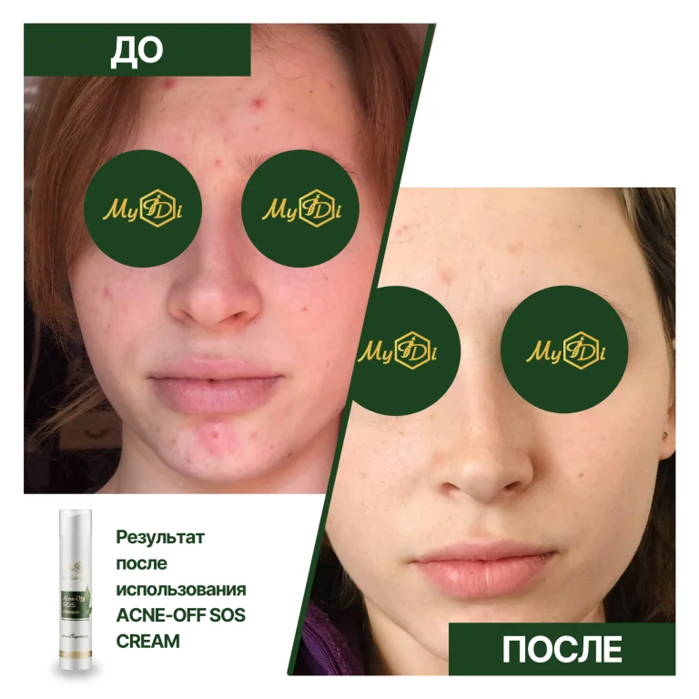 Противовоспалительный крем для лица для проблемной кожи Acne-Off SOS cream (пробник), 5 мл - фото №2