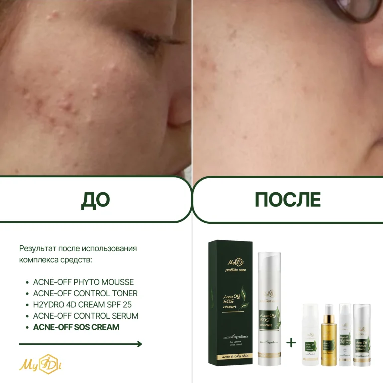 Противовоспалительный крем для лица для проблемной кожи Acne-Off SOS cream (пробник), 5 мл - фото №5