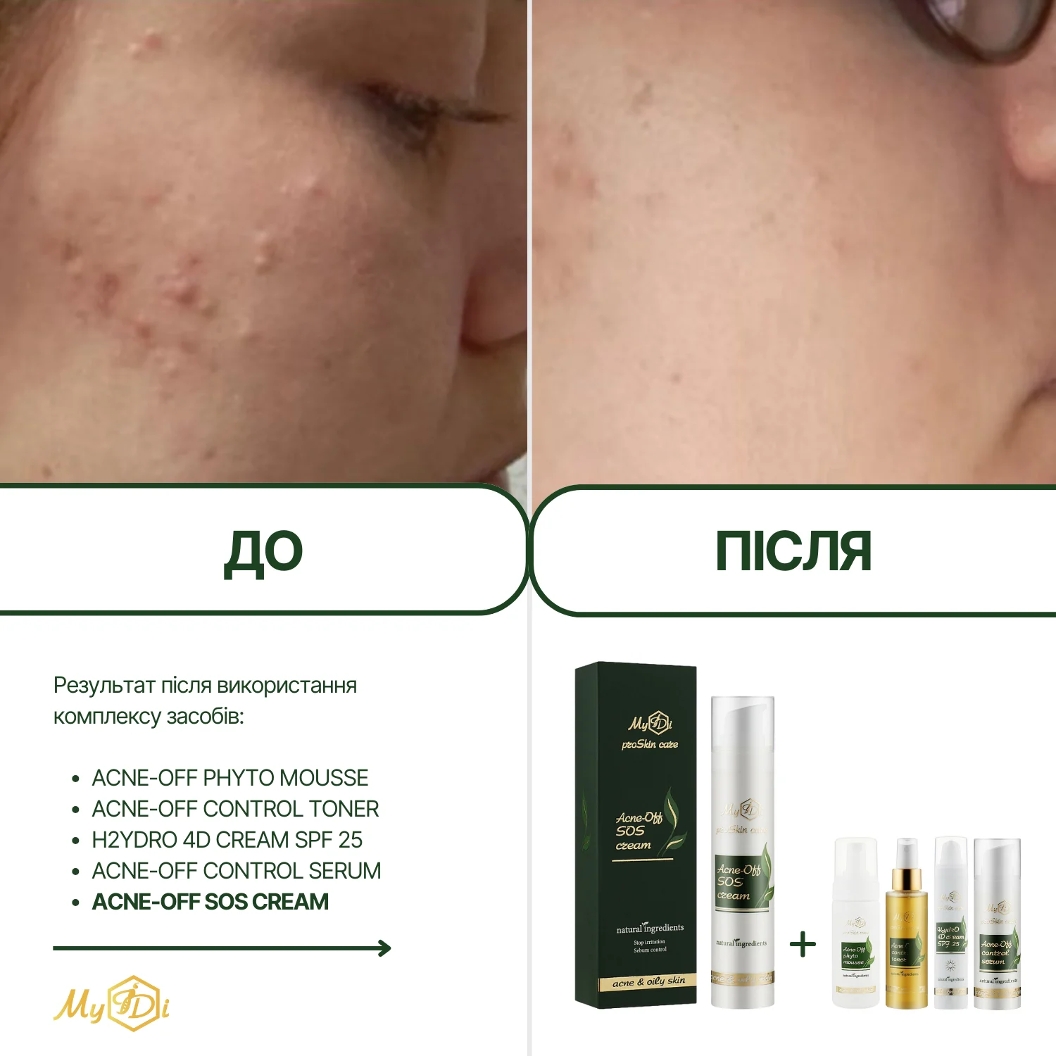Анти акне крем с кислотами для жирной кожи Acne-Off SOS cream (пробник), 5 мл - фото №5