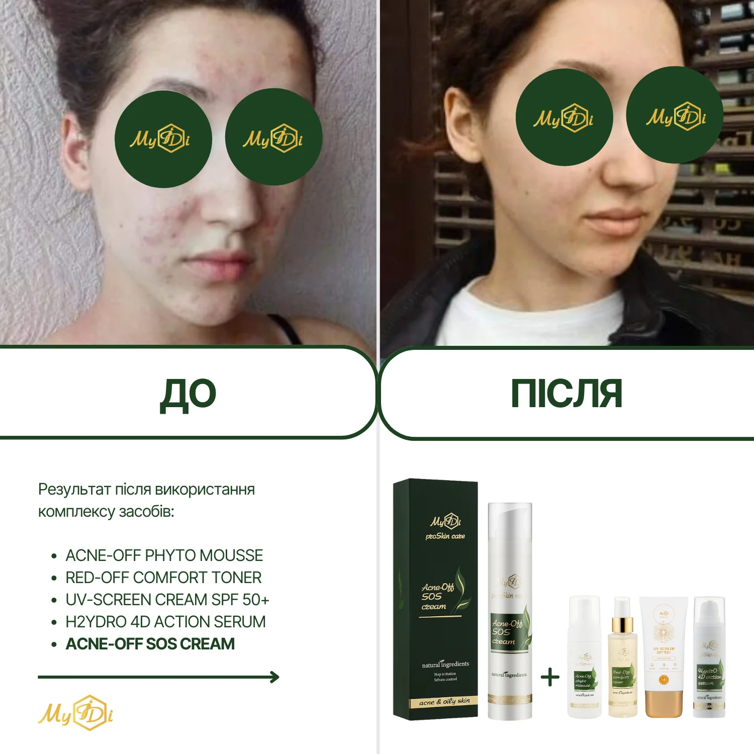 Анти акне крем с кислотами для жирной кожи Acne-Off SOS cream (пробник), 5 мл - фото №4