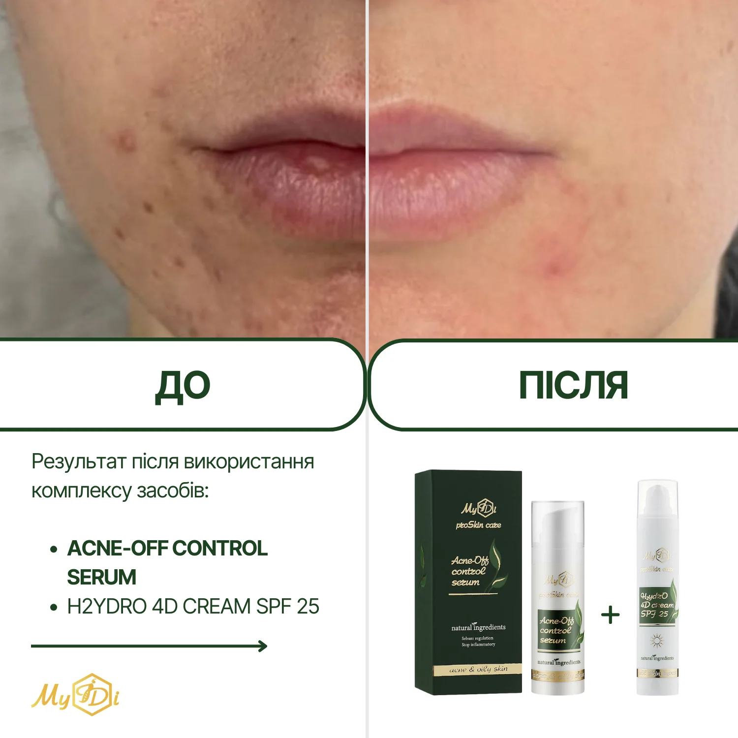 Противовоспалительная сыворотка для лица  Acne-Off control serum (пробник), 5 мл - фото №7