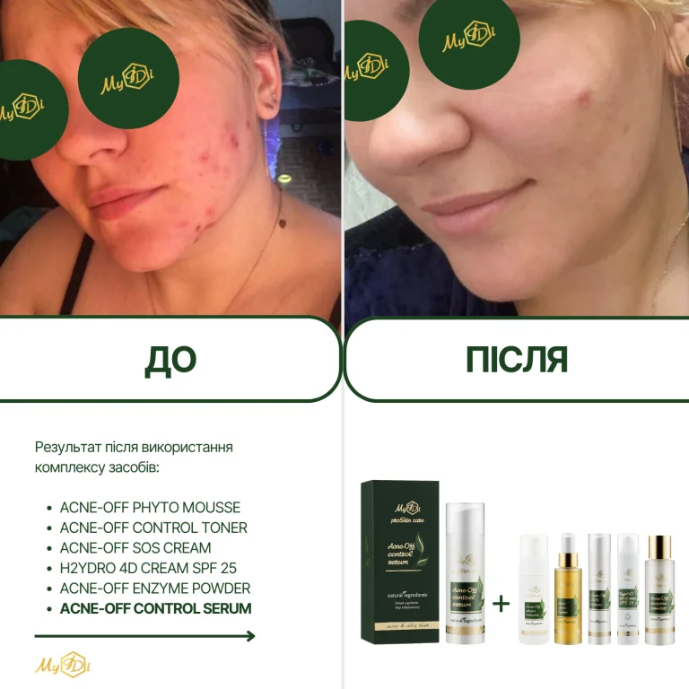 Протизапальна сироватка для обличчя Acne-Off control serum (пробник), 5 мл - фото №6