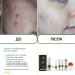 Протизапальна сироватка для обличчя Acne-Off control serum (пробник), 5 мл - фото №5