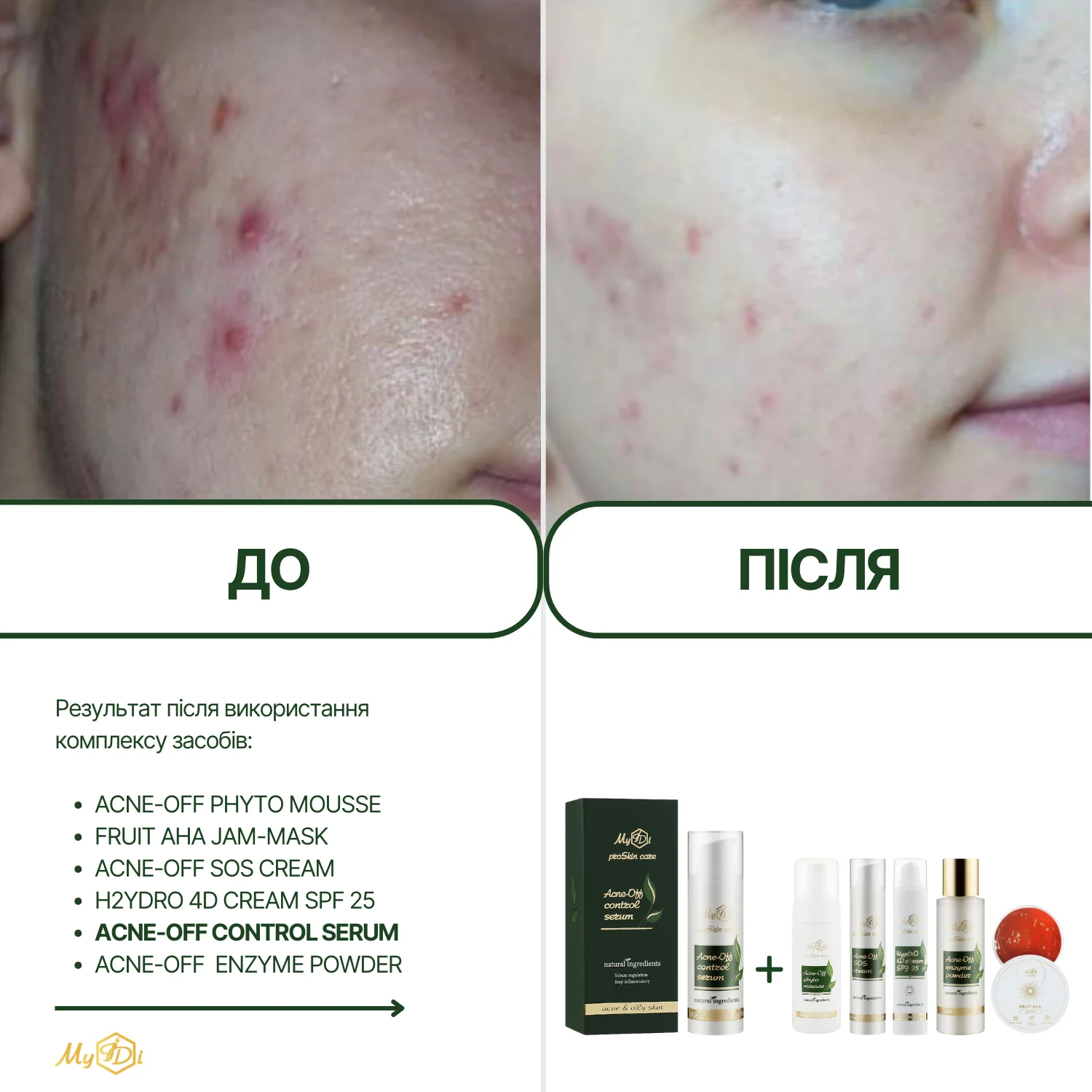 Противовоспалительная сыворотка для лица  Acne-Off control serum (пробник), 5 мл - фото №5