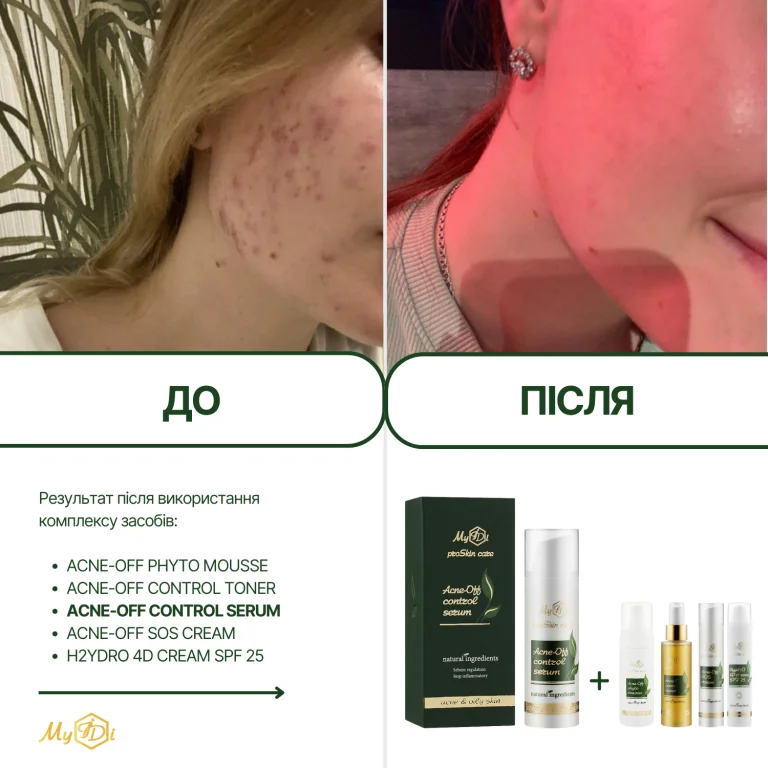 Протизапальна сироватка для обличчя Acne-Off control serum (пробник), 5 мл - фото №4