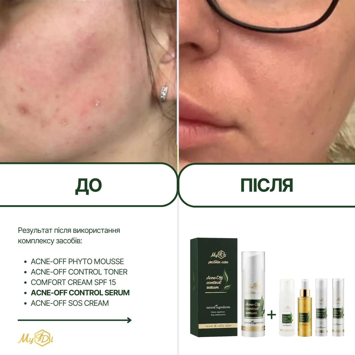 Противовоспалительная сыворотка для лица  Acne-Off control serum (пробник), 5 мл - фото №3