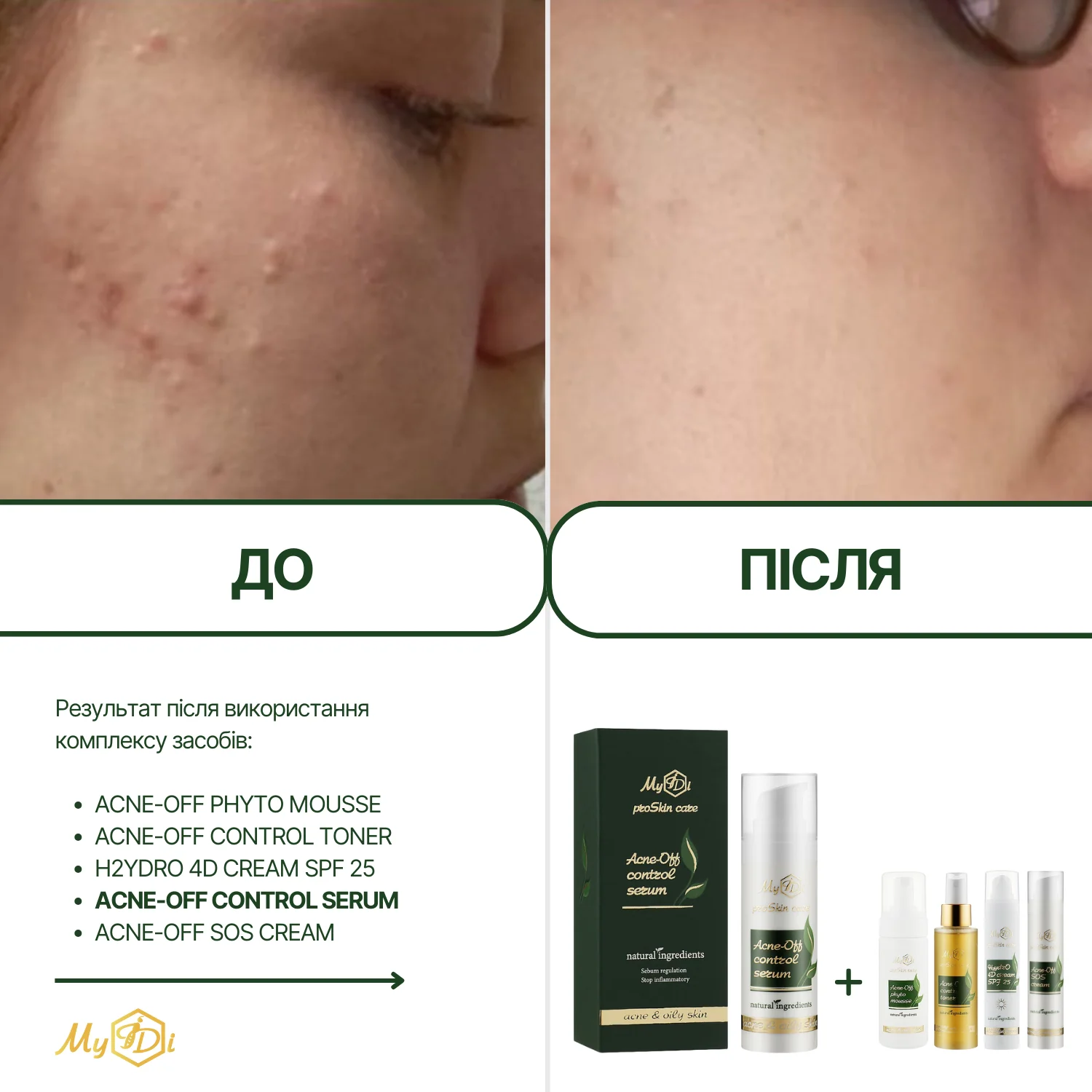 Противовоспалительная сыворотка для лица  Acne-Off control serum (пробник), 5 мл - фото №2
