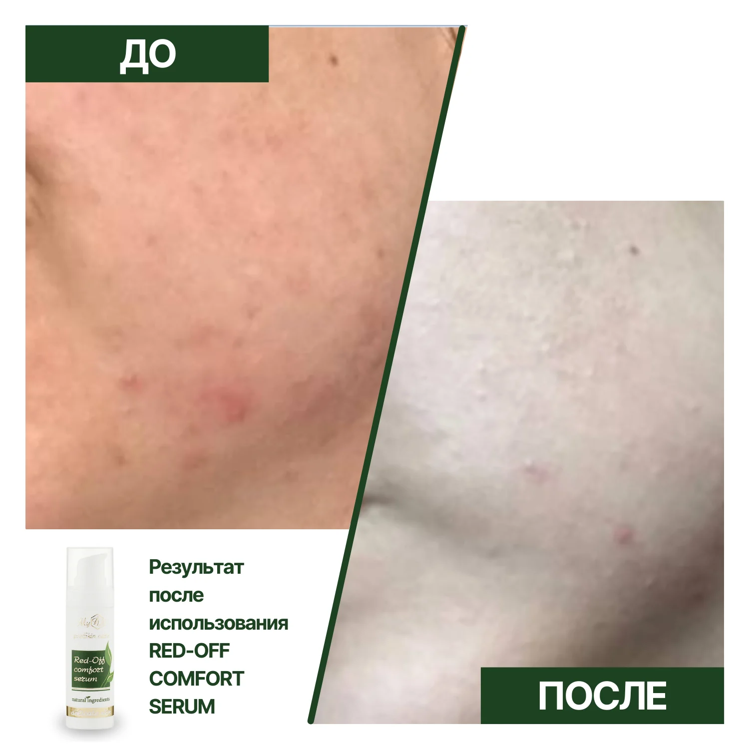 Натуральная сыворотка для лица от покраснений Red-Off comfort serum (пробник), 5 мл - фото №2