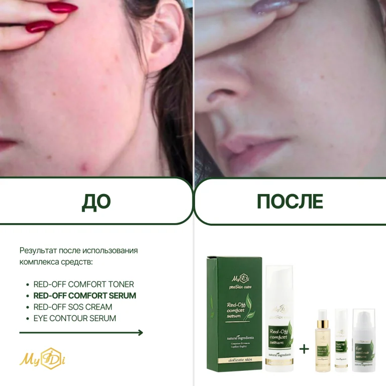 Успокаивающая сыворотка для лица Red-Off comfort serum (пробник), 5 мл - фото №3