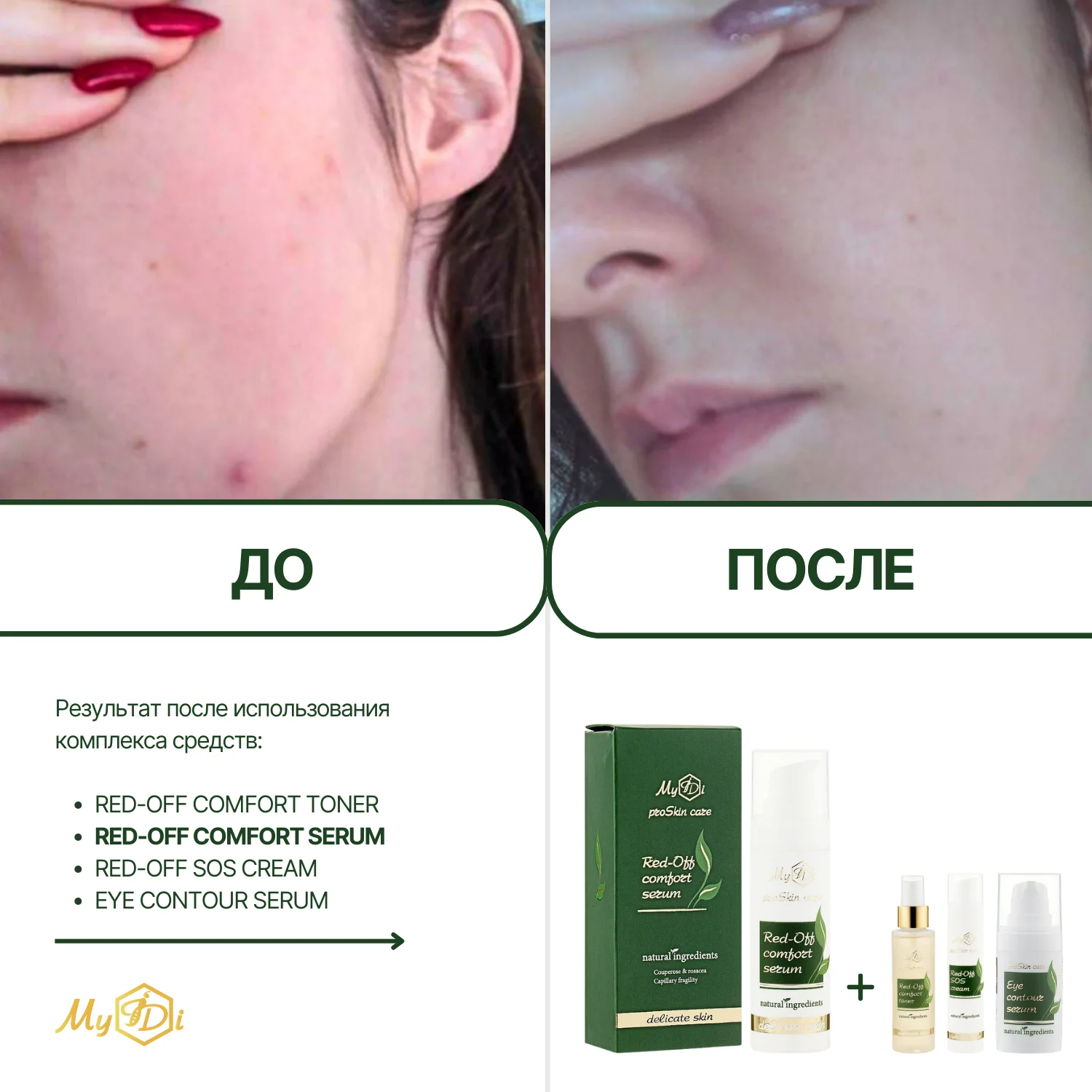 Натуральная сыворотка для лица от покраснений Red-Off comfort serum (пробник), 5 мл - фото №3