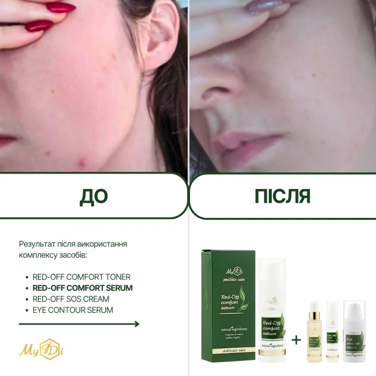 Заспокійлива сироватка для обличчя Red-Off comfort serum, 30 мл - фото №2