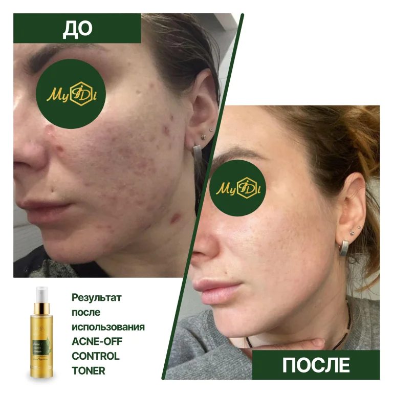 Противовоспалительный тоник для проблемной кожи Acne-Off control toner (миниатюра), 50 мл - фото №3