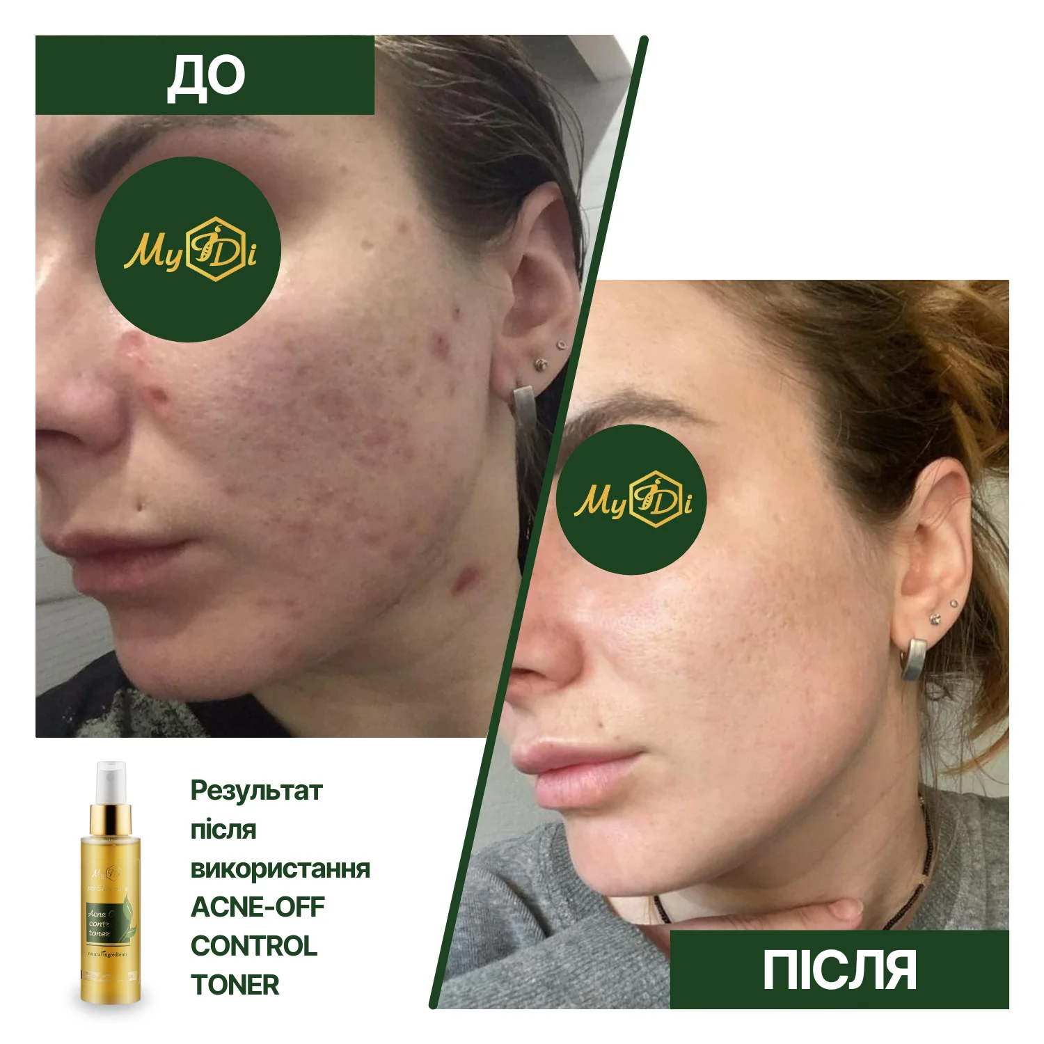 Протизапальний освітлюючий тонер для обличчя Acne-Off control toner, 100 мл - фото №6