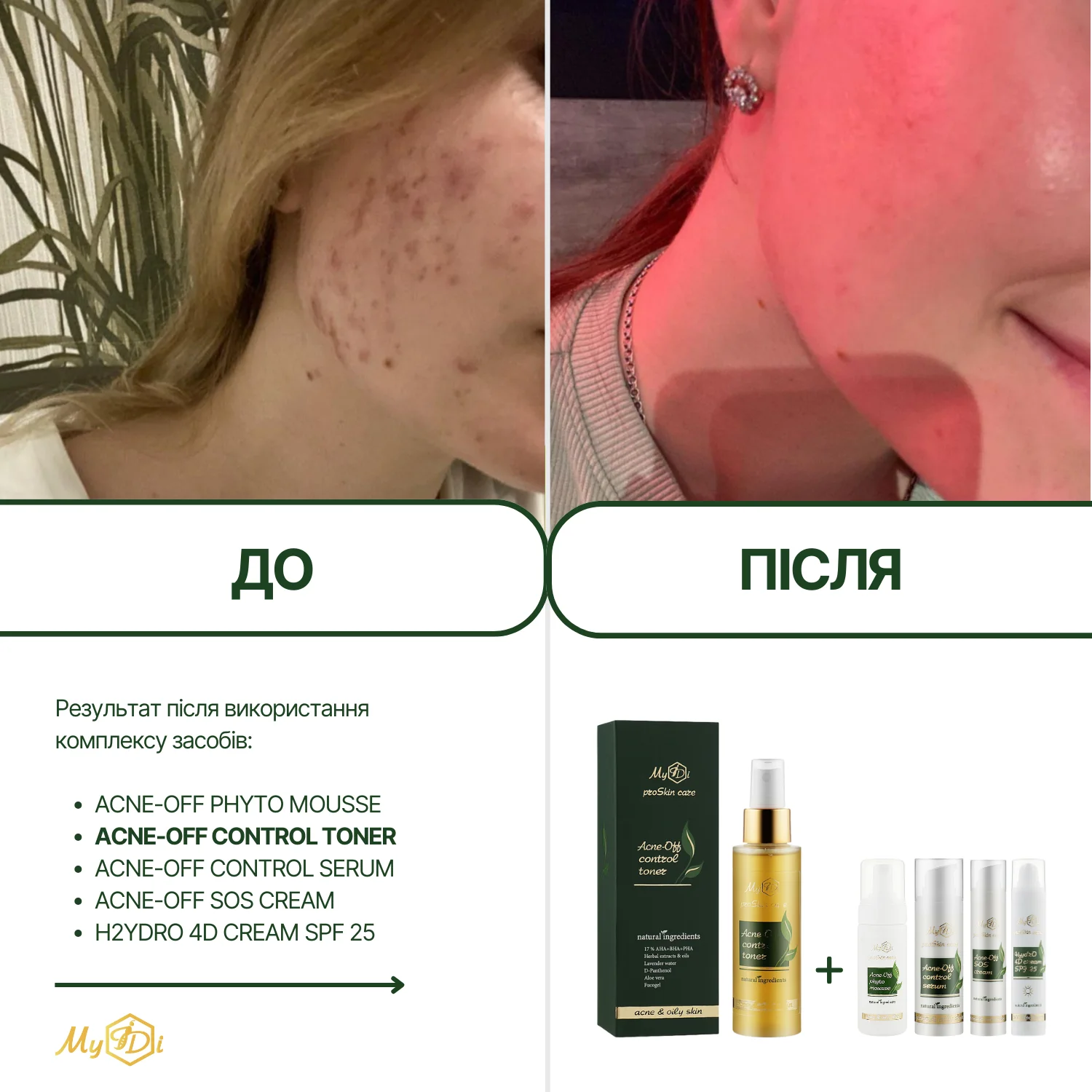 Протизапальний освітлюючий тонер для обличчя Acne-Off control toner, 100 мл - фото №4
