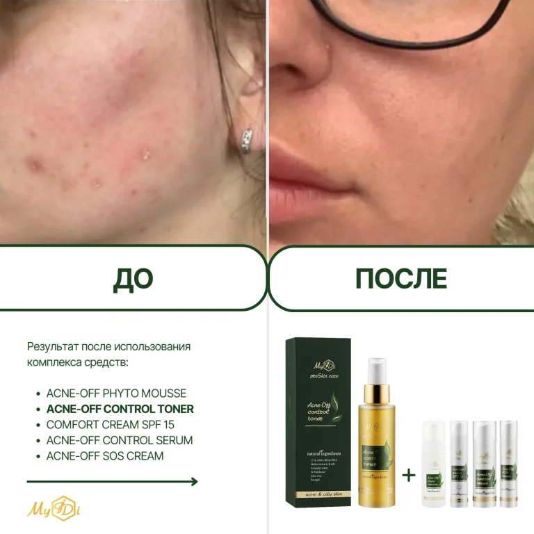 Противовоспалительный тоник для проблемной кожи Acne-Off control toner (миниатюра), 50 мл - фото №5