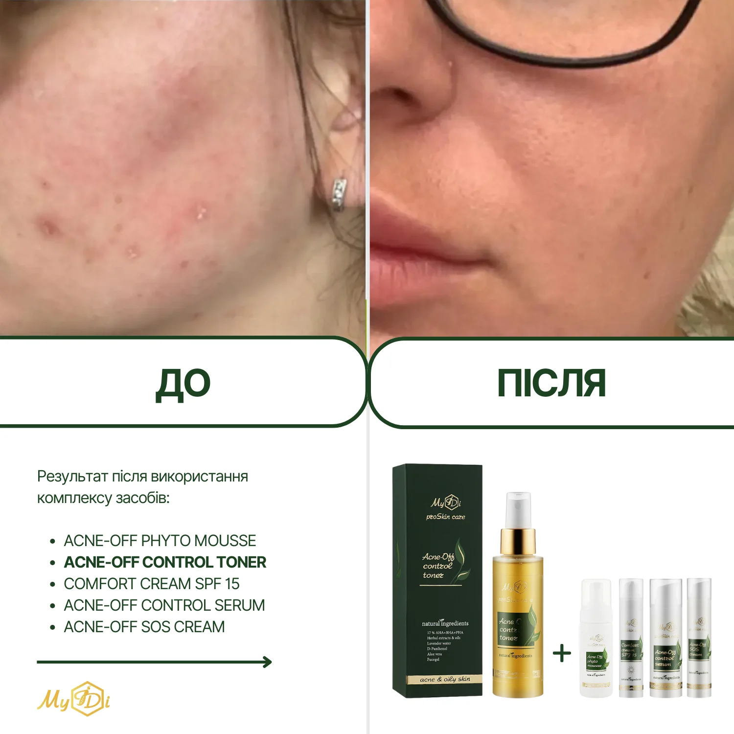 Протизапальний освітлюючий тонер для обличчя Acne-Off control toner, 100 мл - фото №3