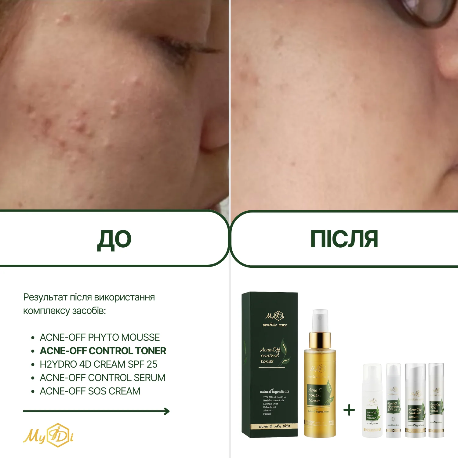 Протизапальний освітлюючий тонер для обличчя Acne-Off control toner, 100 мл - фото №2