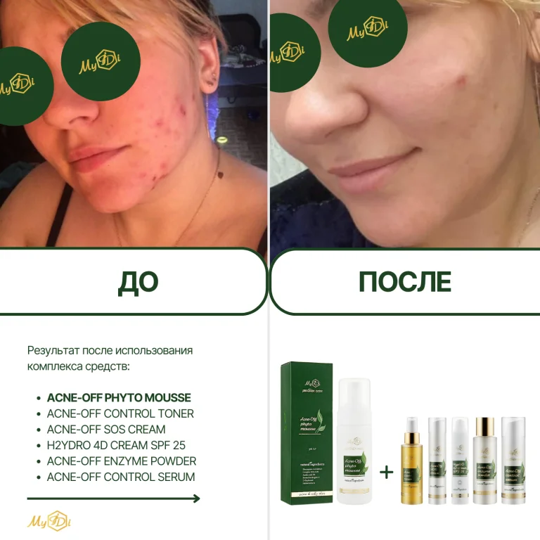 Мусс очищающий для проблемной кожи Acne-Off phyto mousse, 150 мл - фото №8