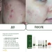 Мусс очищающий для проблемной кожи Acne-Off phyto mousse, 150 мл - фото №7