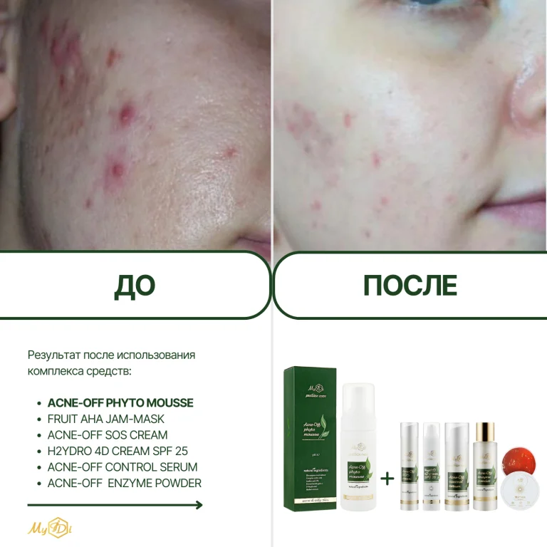 Мусс очищающий для проблемной кожи Acne-Off phyto mousse, 150 мл - фото №7