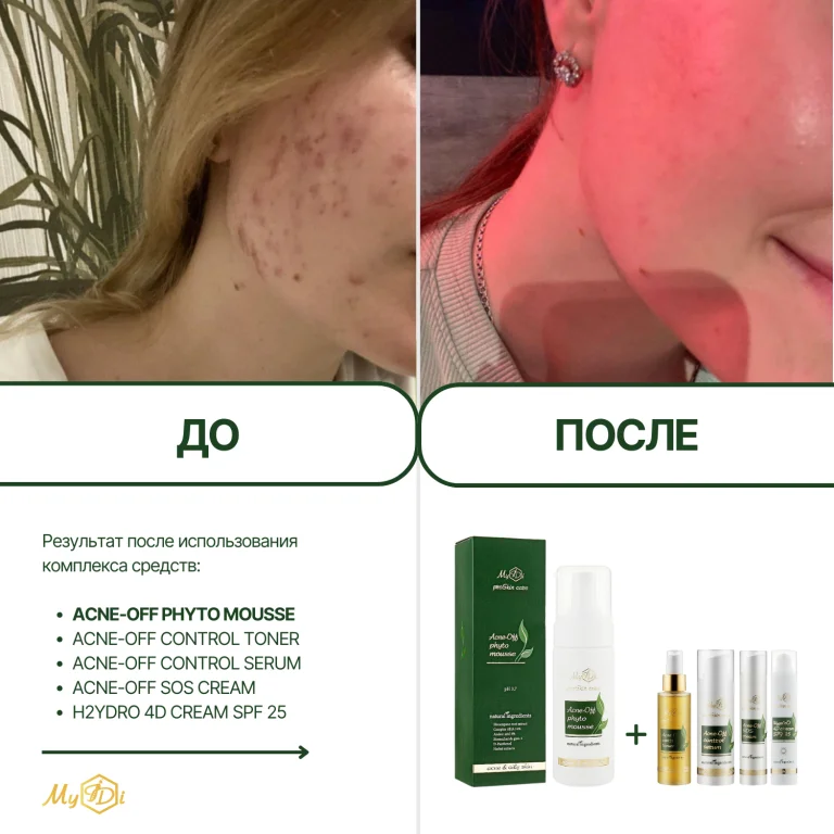 Мусс очищающий для проблемной кожи Acne-Off phyto mousse, 150 мл - фото №6