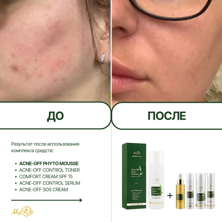 Мусс очищающий для проблемной кожи Acne-Off phyto mousse, 150 мл - фото №5