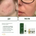 Очищаючий мус для проблемної шкіри Acne-Off phyto mousse (мініатюра), 80 мл - фото №6