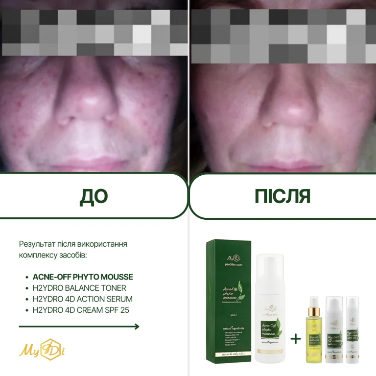 Очищаючий мус для проблемної шкіри Acne-Off phyto mousse (мініатюра), 80 мл - фото №5